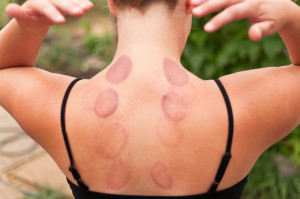 cupping bruises